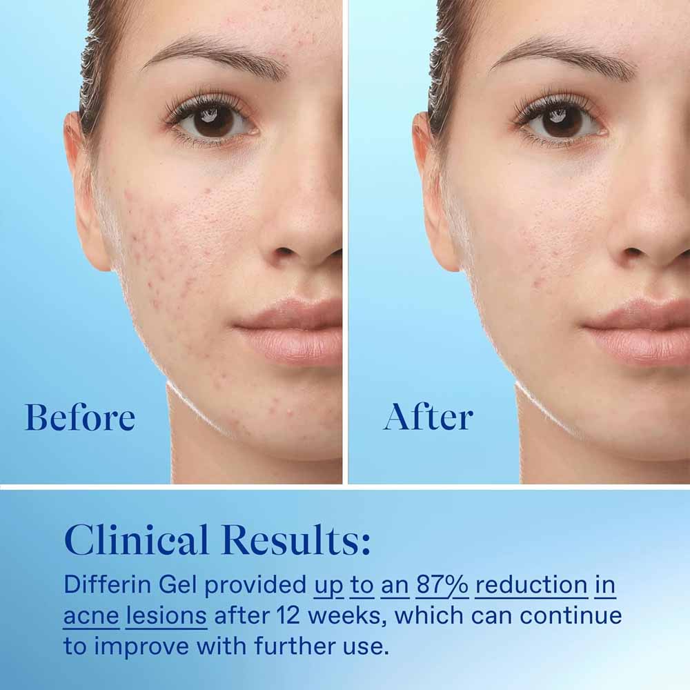 Differin Gel Acne Treatment 15g 4