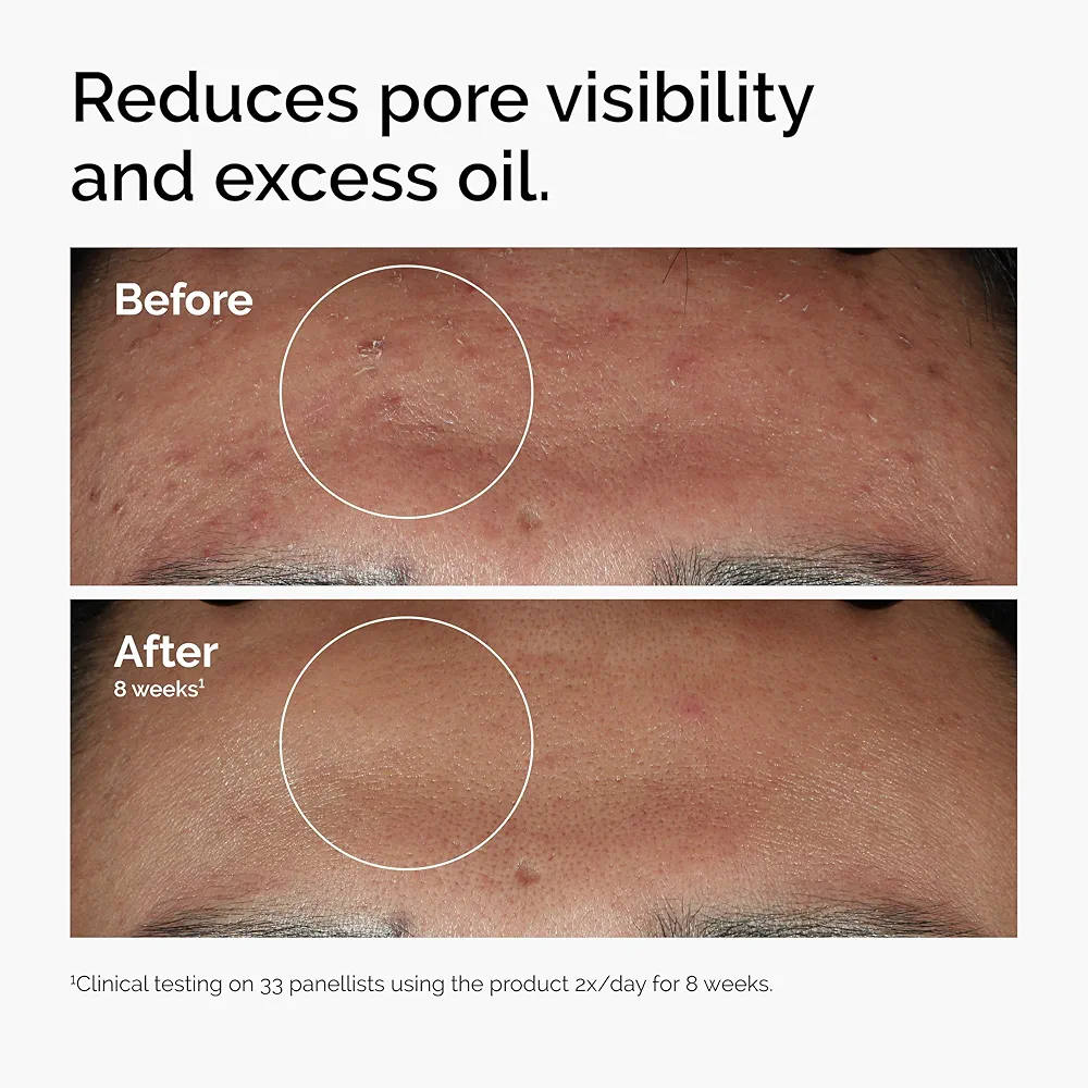 The Ordinary Niacinamide 10% + Zinc 1% 30ml 3